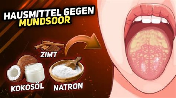 Was kann man essen bei mundsoor?