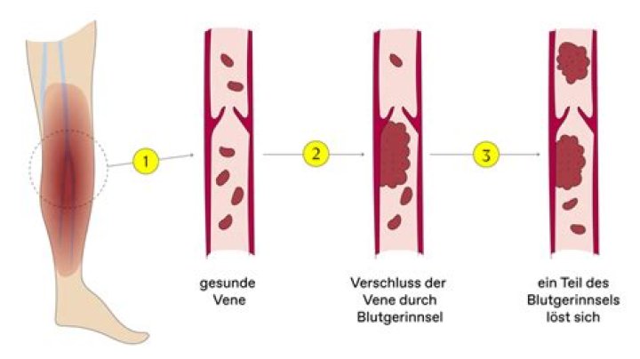Was macht man bei Verdacht auf Thrombose?