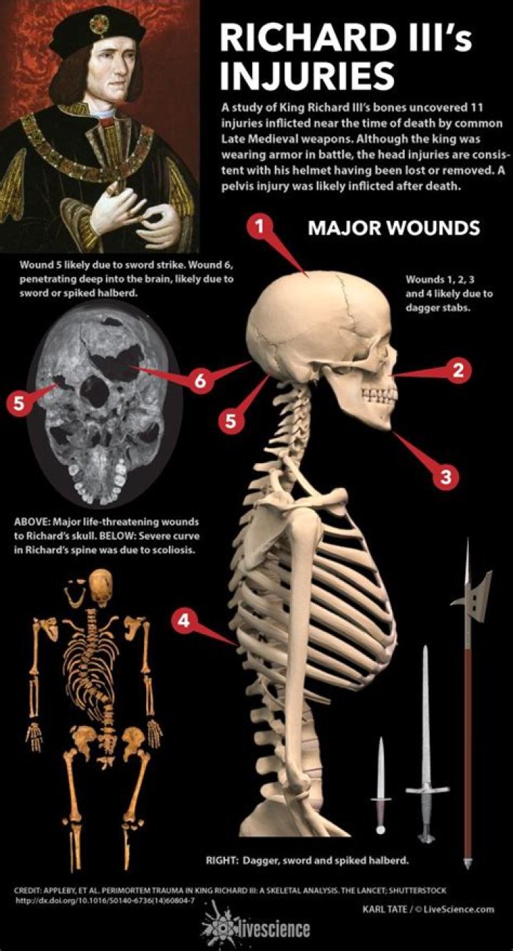Was Richard III really deformed?