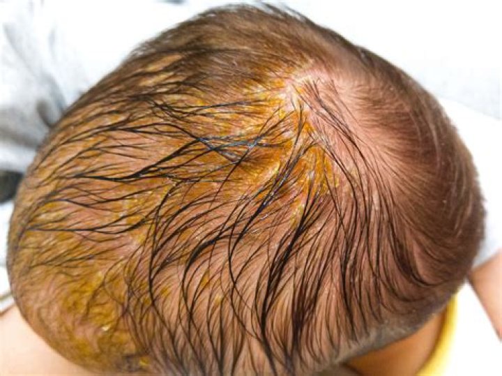 Was tun bei trockener Kopfhaut Baby?