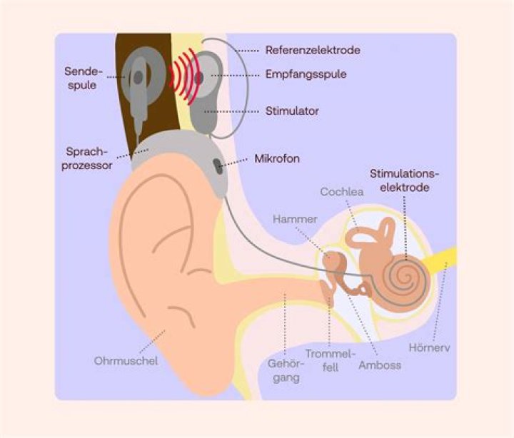 Wer braucht ein Cochlea-Implantat?