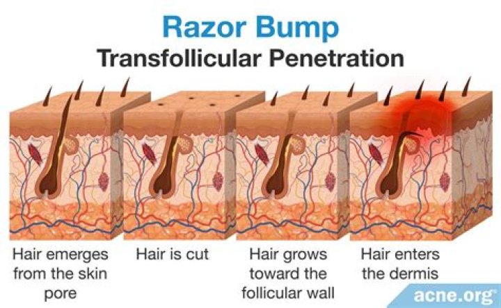 What's inside a razor bump?