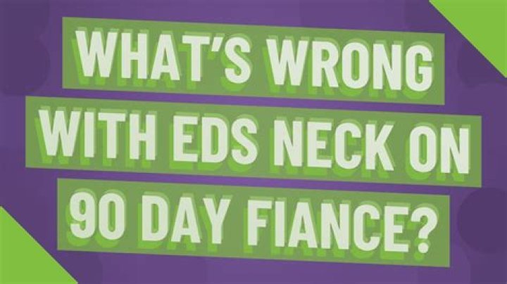 What's wrong with EDS neck on 90 day fiance?