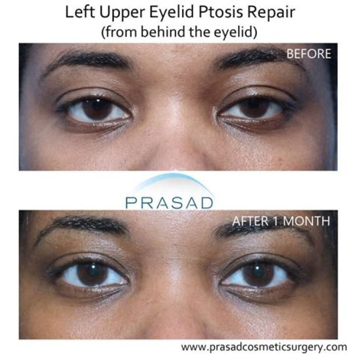 What are asymmetrical eyes?