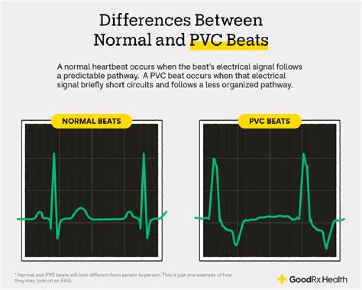 What are PVC's on an ECG?