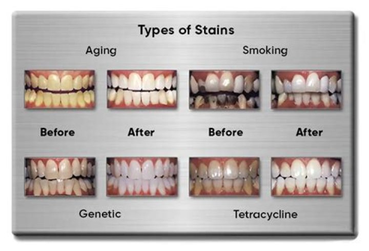 What are the classification of stains?