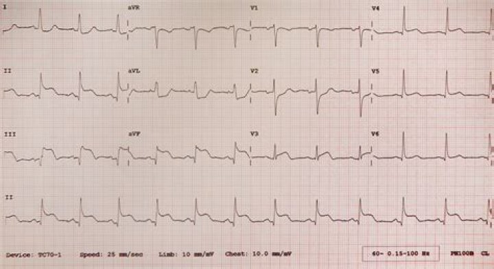 What are the ECG changes associated with pain in a patient with angina pectoris with possible MI?