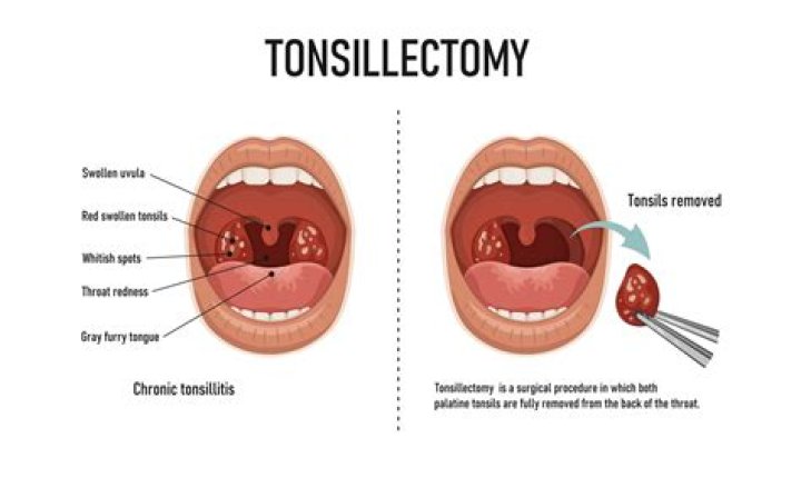 What are the long term effects of getting your tonsils removed?