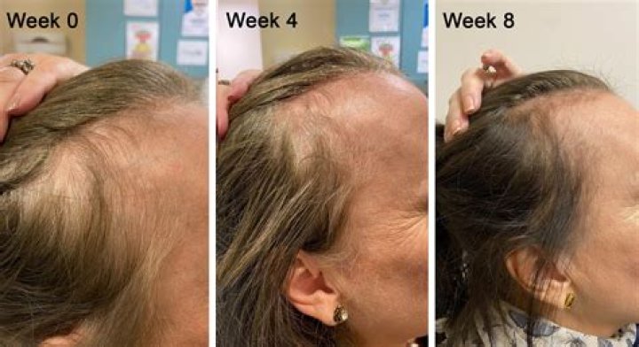 What birth control is best for hair loss?