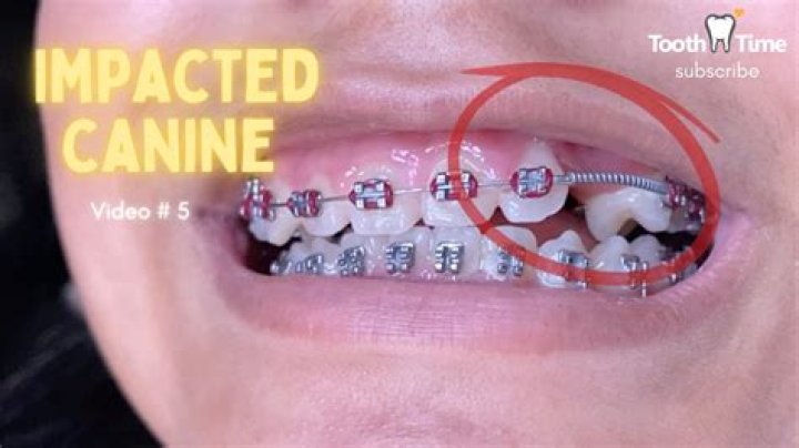 What can you do for impacted canine teeth?
