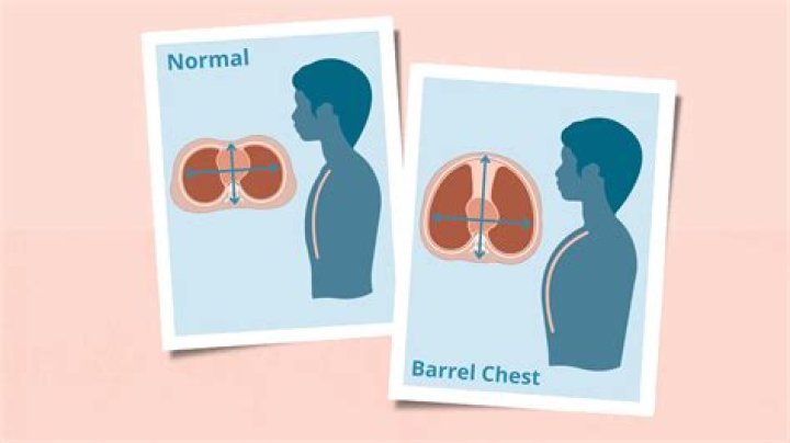 What causes a barrel shaped chest?