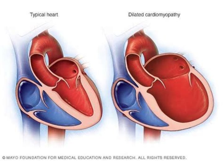 What causes a dilated ventricle?