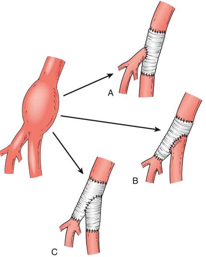 What causes a femoral artery aneurysm?