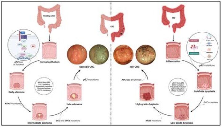 What causes adenocarcinoma of the colon?