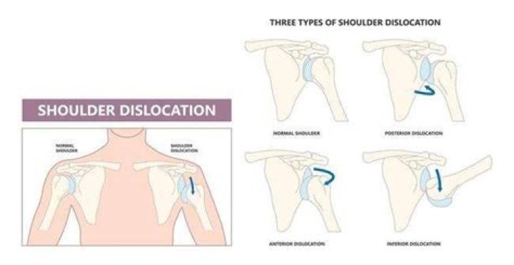 What causes dislocation?