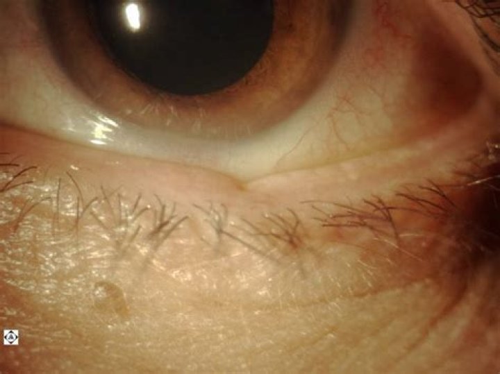 What causes eyelid notching?