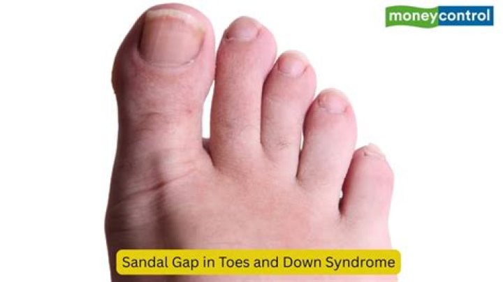 What causes gap between toes?