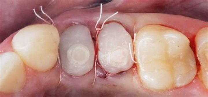 What causes loss of dentin?