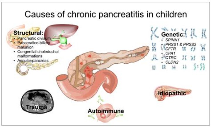 What causes pancreatitis in a child?