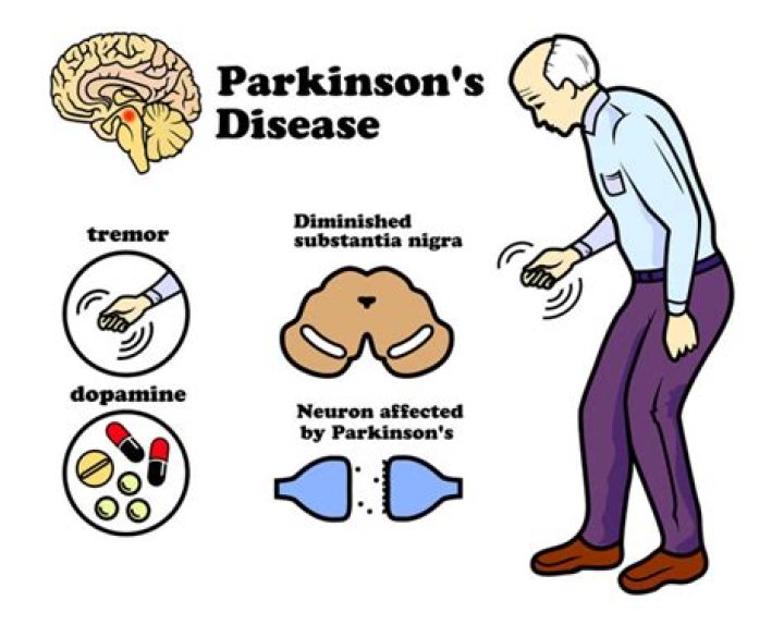What causes rigidity in Parkinson's disease?