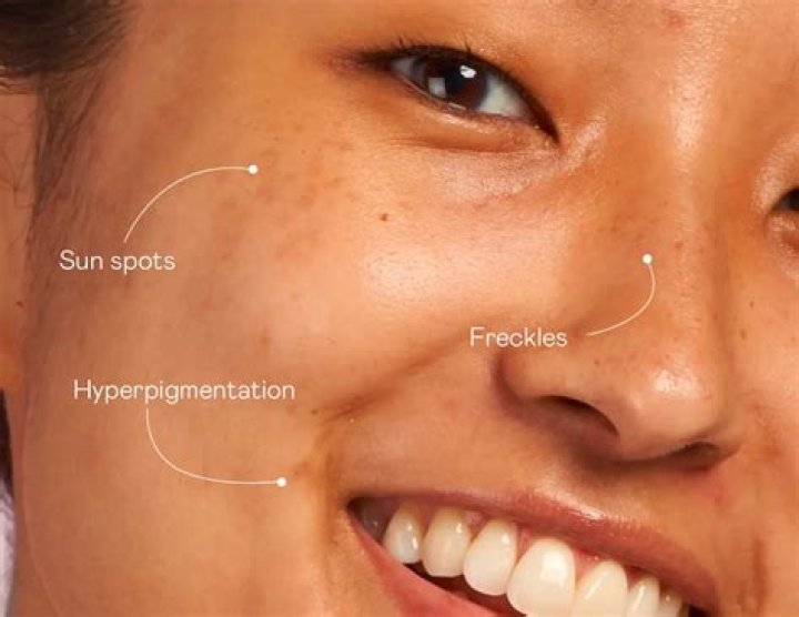 What causes sun spots on your face?