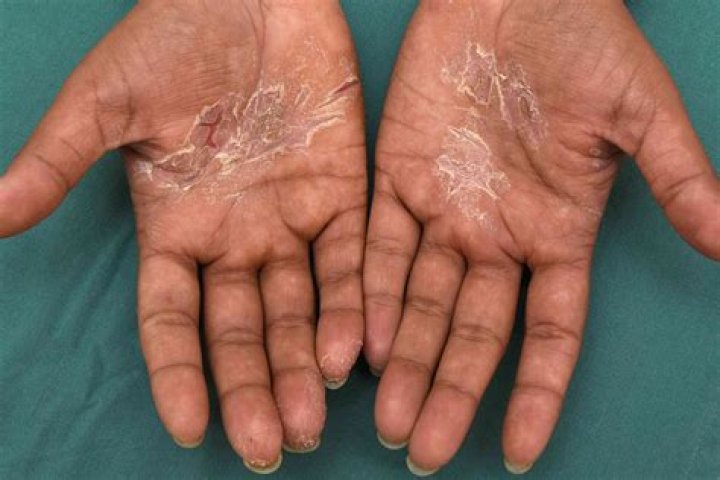 What causes thick skin hands?