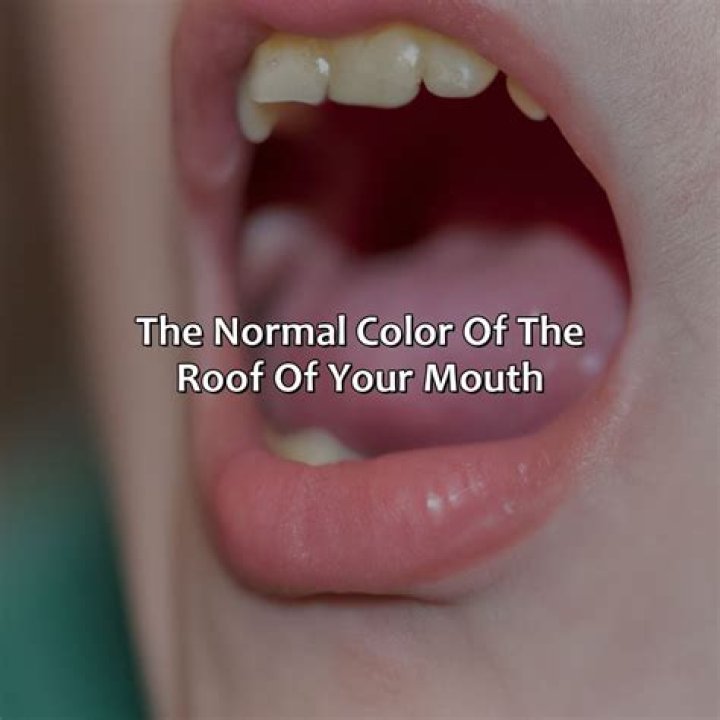 What color should the roof of your mouth be?