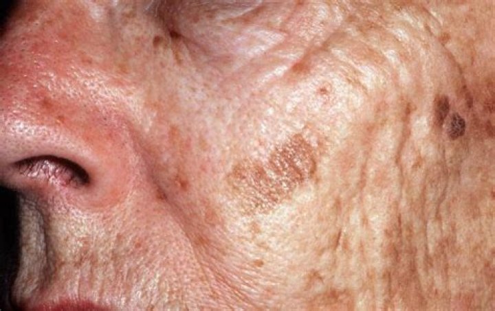 What do raised age spots look like?