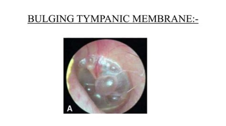 What does a bulging tympanic membrane indicate?