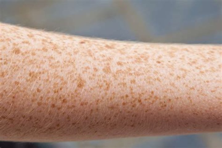 What does a freckle on your armpit mean?