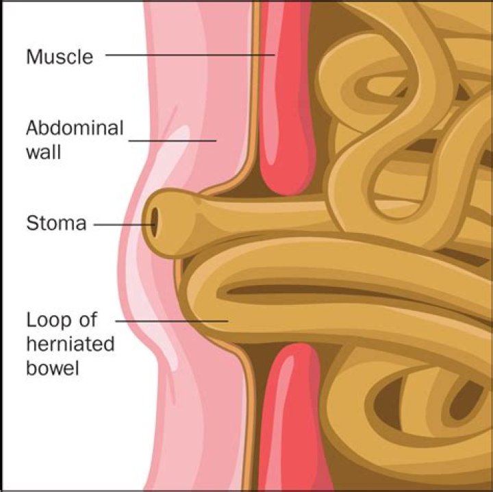 What does a stoma hernia feel like?