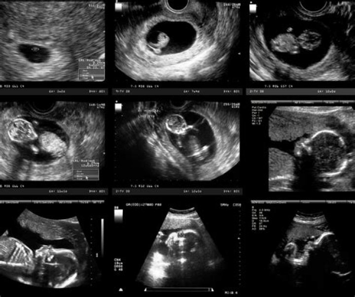 What does an ultrasound show about the baby?
