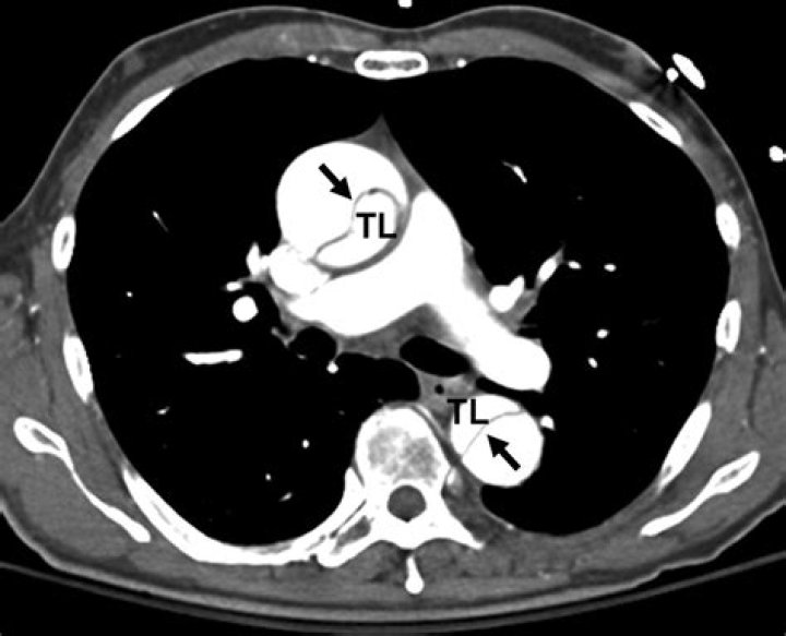 What does aortic dissection look like on CT?