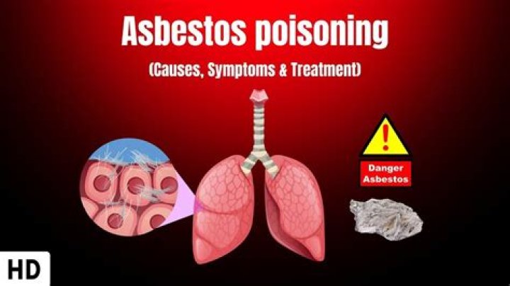 What does asbestosis look like on an X ray?