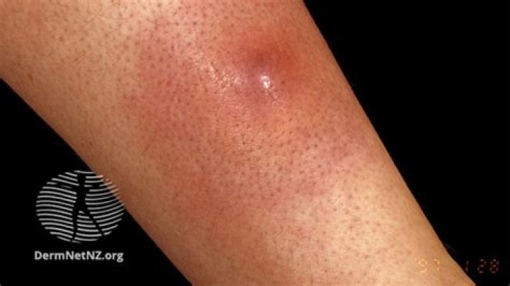 What does blood boil mean?