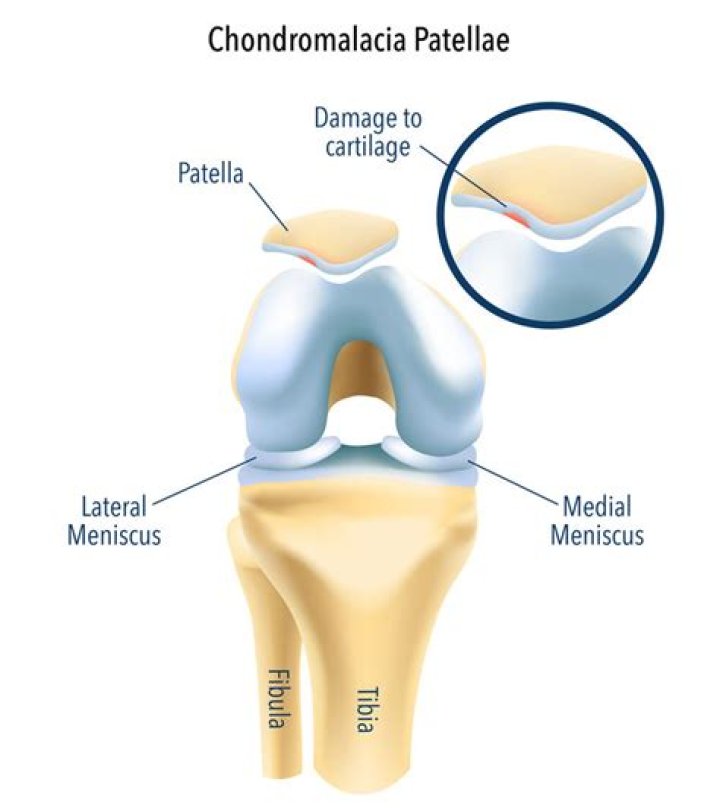 What does chondral mean in medical terms?
