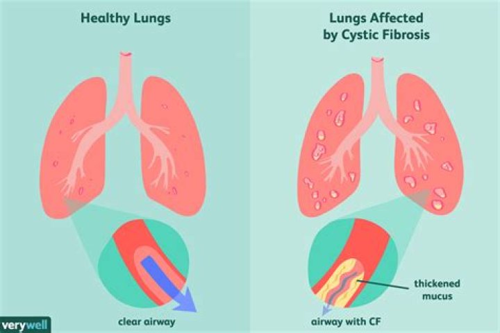 What does cystic fibrosis do to the heart?