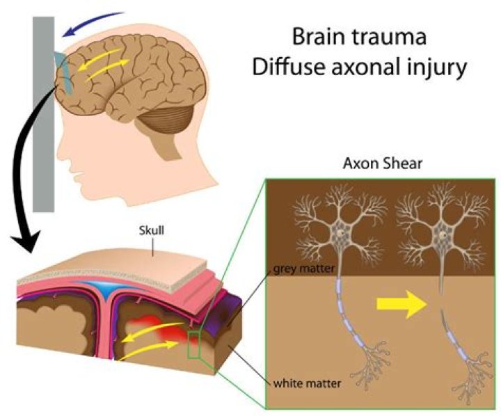 What does diffuse TBI mean?