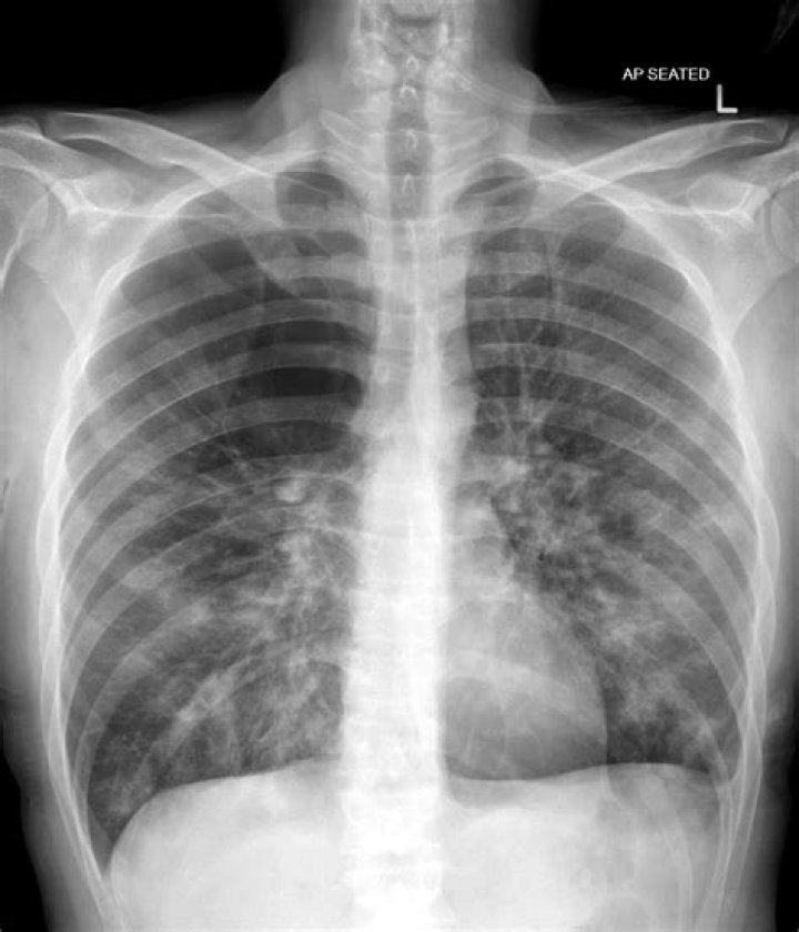 What does emphysema look like on a chest X ray?