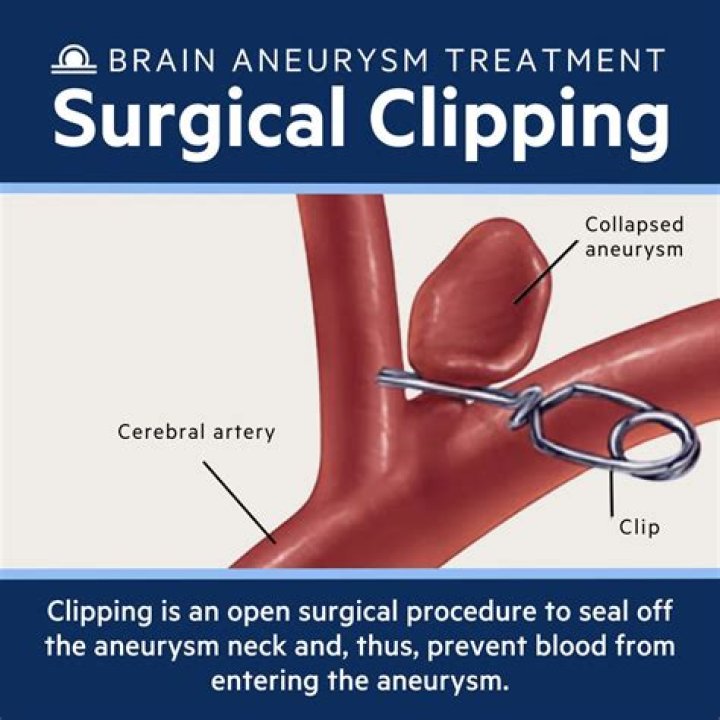 What does getting clipped mean?