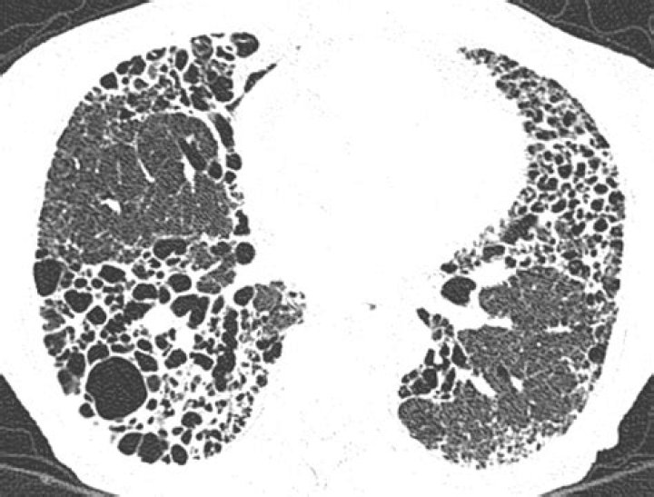 What does Honeycombing in lungs mean?
