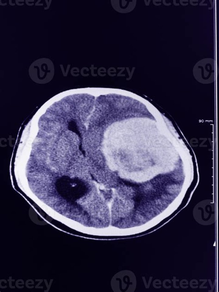What does Hyperdense on CT mean?