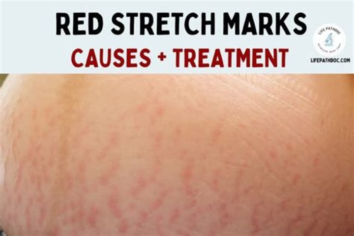 What does it mean if my stretch marks are red?