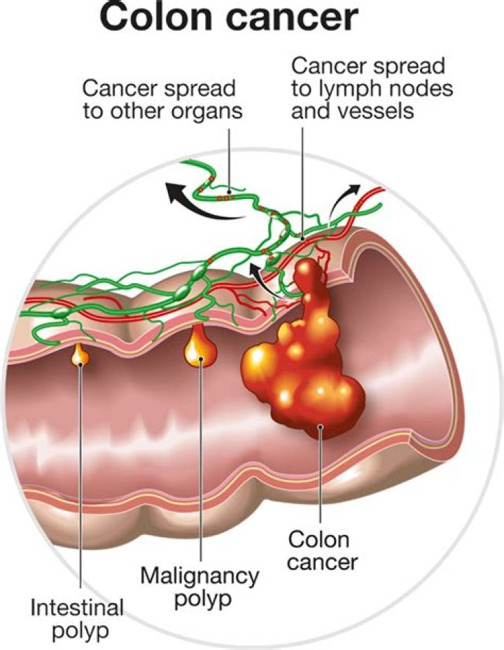 What does it mean when colon cancer spreads to lymph nodes?