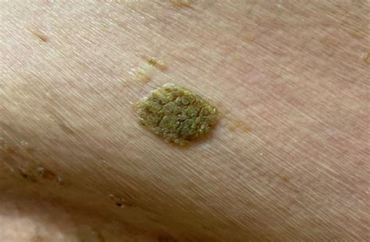 What happens if a mole gets infected?