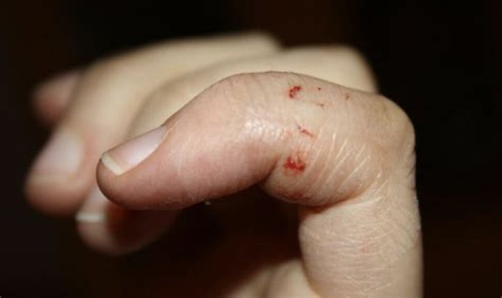 What happens if a mouse scratches you?