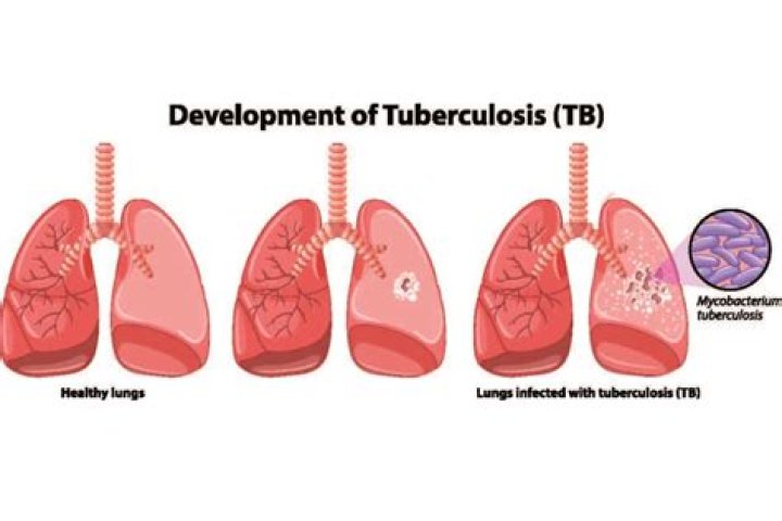 What happens to lungs after tuberculosis?