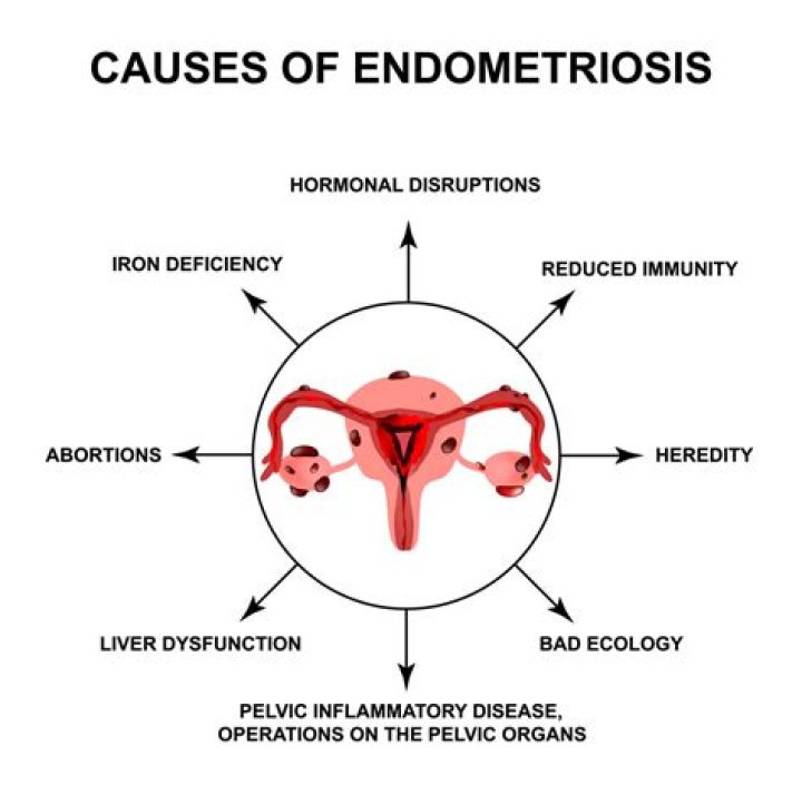 What happens when endometriosis is left untreated?