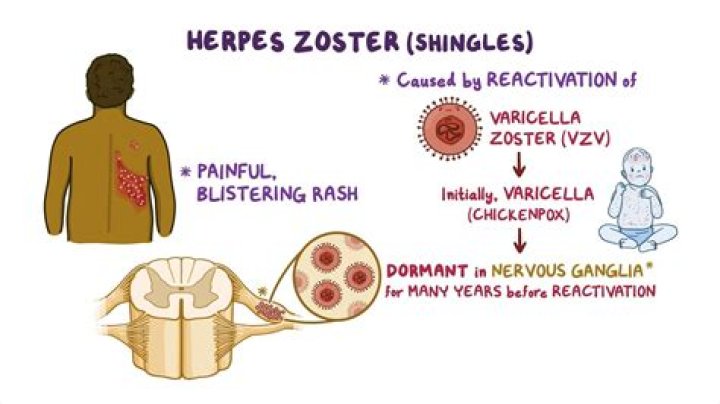 What helps nerve pain from herpes?
