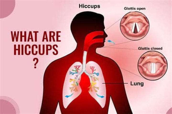 What helps with hiccups after stroke?